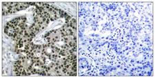 HSF1 Antibody - Immunohistochemistry analysis of paraffin-embedded human breast carcinoma, using HSF1 (Phospho-Ser303) Antibody. The picture on the right is blocked with the phospho peptide.