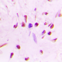 HSF1 Antibody - Immunohistochemical analysis of HSF1 (pS303) staining in human lung cancer formalin fixed paraffin embedded tissue section. The section was pre-treated using heat mediated antigen retrieval with sodium citrate buffer (pH 6.0). The section was then incubated with the antibody at room temperature and detected using an HRP conjugated compact polymer system. DAB was used as the chromogen. The section was then counterstained with hematoxylin and mounted with DPX.