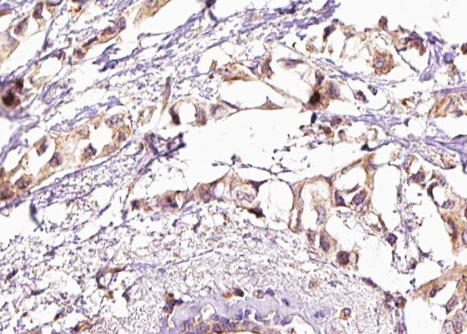 HSF1 Antibody - 1:100 staining human breast carcinoma tissue by IHC-P. The tissue was formaldehyde fixed and a heat mediated antigen retrieval step in citrate buffer was performed. The tissue was then blocked and incubated with the antibody for 1.5 hours at 22°C. An HRP conjugated goat anti-rabbit antibody was used as the secondary.