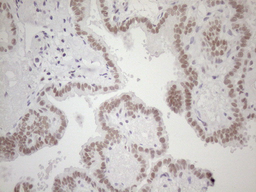 HSF2 Antibody - Immunohistochemical staining of paraffin-embedded Carcinoma of Human thyroid tissue using anti-HSF2 mouse monoclonal antibody. (Heat-induced epitope retrieval by 1mM EDTA in 10mM Tris buffer. (pH8.5) at 120 oC for 3 min. (1:150)