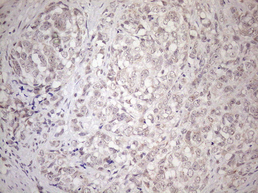 HSF2 Antibody - Immunohistochemical staining of paraffin-embedded Adenocarcinoma of Human endometrium tissue using anti-HSF2 mouse monoclonal antibody. (Heat-induced epitope retrieval by 1mM EDTA in 10mM Tris buffer. (pH8.5) at 120 oC for 3 min. (1:150)