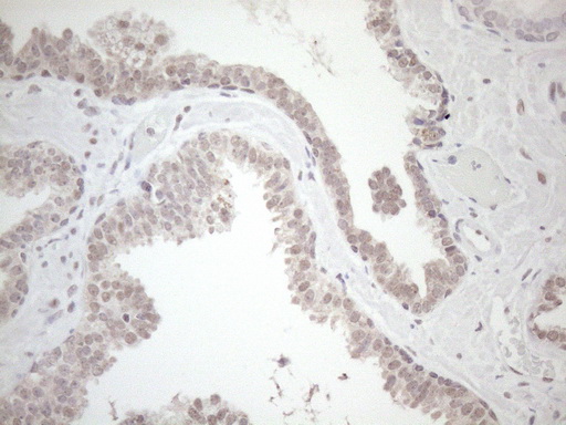 HSF2 Antibody - Immunohistochemical staining of paraffin-embedded Carcinoma of Human prostate tissue using anti-HSF2 mouse monoclonal antibody. (Heat-induced epitope retrieval by 1mM EDTA in 10mM Tris buffer. (pH8.5) at 120 oC for 3 min. (1:150)