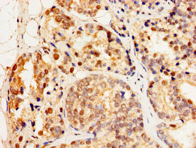 HSF2 Antibody - Immunohistochemistry image of paraffin-embedded human prostate cancer at a dilution of 1:100