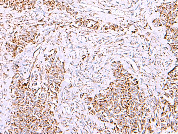 HSF2BP Antibody - Immunohistochemistry of paraffin-embedded Human ovarian cancer tissue  using HSF2BP Polyclonal Antibody at dilution of 1:30(×200)