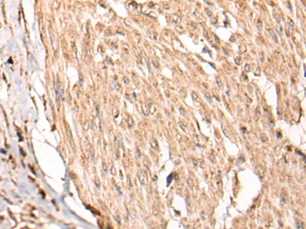 HSF4 Antibody - Immunohistochemistry of paraffin-embedded Human cervical cancer tissue  using HSF4  Polyclonal Antibody at dilution of 1:55(×200)