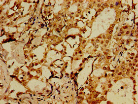 HSorCS / SORCS1 Antibody - Immunohistochemistry image of paraffin-embedded human breast cancer at a dilution of 1:100