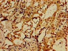 HSorCS / SORCS1 Antibody - Immunohistochemistry image of paraffin-embedded human breast cancer at a dilution of 1:100