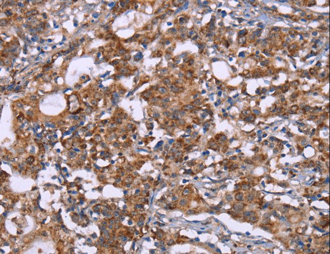 HSP10 / Cpn10 / Chaperonin 10 Antibody - Immunohistochemistry of paraffin-embedded Human gastric cancer using HSPE1 Polyclonal Antibody at dilution of 1:40.