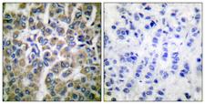 HSP10 / Cpn10 / Chaperonin 10 Antibody - Peptide - + Immunohistochemical analysis of paraffin-embedded human breast carcinoma tissue using HSP10 antibody.