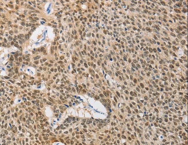 HSP40 Antibody - Immunohistochemistry of paraffin-embedded Human lung cancer using DNAJB1 Polyclonal Antibody at dilution of 1:40.