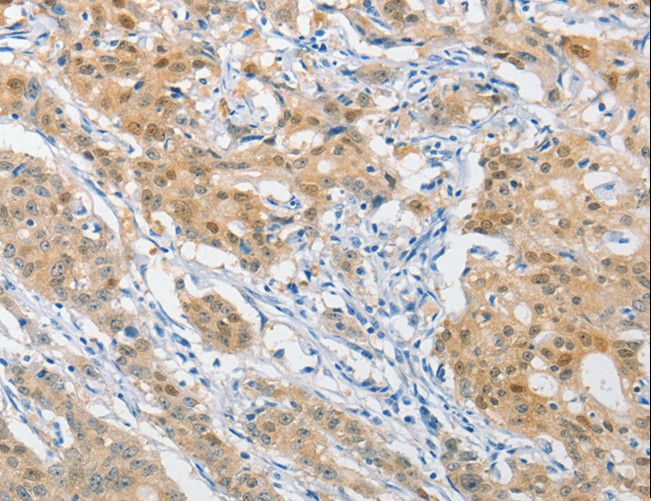 HSP40 Antibody - Immunohistochemistry of paraffin-embedded Human gastric cancer using DNAJB1 Polyclonal Antibody at dilution of 1:40.