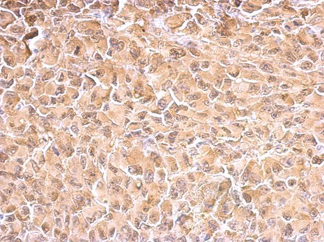 HSP70 / Heat Shock Protein 70 Antibody - HSP70 1A antibody detects HSPA1A protein at cytosol on H1299 xenograft by immunohistochemical analysis. Sample: Paraffin-embedded H1299 xenograft. HSP70 1A antibody dilution:1:500.