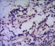 HSP70 / Heat Shock Protein 70 Antibody - IHC of paraffin-embedded human breast cancer using HSP70 mouse mAb with DAB staining.