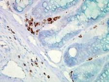 HSP70 / Heat Shock Protein 70 Antibody - Hsp70 (C92) Mouse colon cancer.