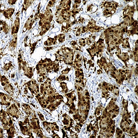 HSP70 / Heat Shock Protein 70 Antibody - Formalin-fixed, paraffin-embedded human breast carcinoma stained with Heat Shock Protein 70 antibody.