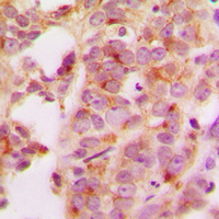 HSP70 / Heat Shock Protein 70 Antibody - Immunohistochemical analysis of HSP70 staining in human breast cancer formalin fixed paraffin embedded tissue section. The section was pre-treated using heat mediated antigen retrieval with sodium citrate buffer (pH 6.0). The section was then incubated with the antibody at room temperature and detected using an HRP conjugated compact polymer system. DAB was used as the chromogen. The section was then counterstained with hematoxylin and mounted with DPX.
