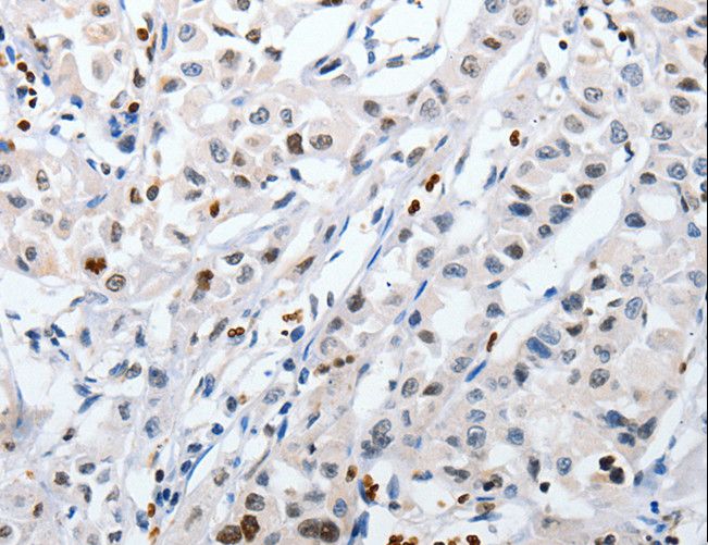 HSP70 / Heat Shock Protein 70 Antibody - Immunohistochemistry of paraffin-embedded Human lung cancer using HSPA1A Polyclonal Antibody at dilution of 1:60.