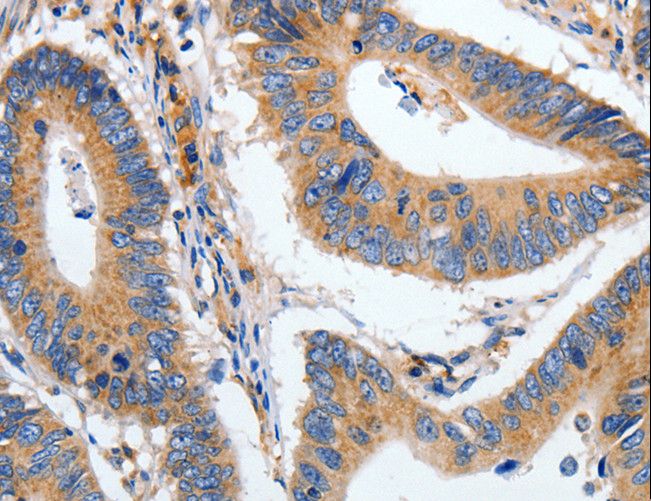 HSP70 / Heat Shock Protein 70 Antibody - Immunohistochemistry of paraffin-embedded Human colon cancer using HSPA1A Polyclonal Antibody at dilution of 1:40.