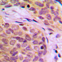 HSP70L1 / HSPA14 Antibody - Immunohistochemical analysis of HSPA14 staining in human breast cancer formalin fixed paraffin embedded tissue section. The section was pre-treated using heat mediated antigen retrieval with sodium citrate buffer (pH 6.0). The section was then incubated with the antibody at room temperature and detected using an HRP conjugated compact polymer system. DAB was used as the chromogen. The section was then counterstained with hematoxylin and mounted with DPX.