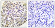 HSP90 Beta Antibody - Immunohistochemistry analysis of paraffin-embedded human breast carcinoma, using HSP90B (Phospho-Ser254) Antibody. The picture on the right is blocked with the phospho peptide.
