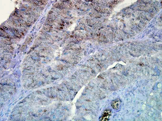 HSP90 / Heat Shock Protein 90 Antibody - Hsp90 (D7alpha), Human colon carcinoma.  This image was taken for the unconjugated form of this product. Other forms have not been tested.