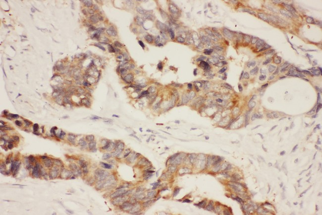 HSP90AA1 / Hsp90 Alpha A1 Antibody - Hsp90 antibody IHC-paraffin: Human Intestinal Cancer Tissue.