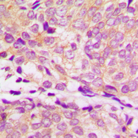 HSP90AA1 / Hsp90 Alpha A1 Antibody - Immunohistochemical analysis of HSP90 alpha staining in human breast cancer formalin fixed paraffin embedded tissue section. The section was pre-treated using heat mediated antigen retrieval with sodium citrate buffer (pH 6.0). The section was then incubated with the antibody at room temperature and detected using an HRP conjugated compact polymer system. DAB was used as the chromogen. The section was then counterstained with hematoxylin and mounted with DPX.