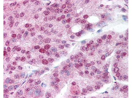 HSP90AA1 / Hsp90 Alpha A1 Antibody - affinity purified anti-Hsp90 acetyl K294 antibody was used at 20 µg/ml to detect signal in a variety of tissues including multi-human, multi-brain and multi-cancer slides. This image shows moderate nuclear and granular cytoplasmic positive staining in human prostate carcinoma at 40X. Tissue was formalin-fixed and paraffin embedded. The image shows localization of the antibody as the precipitated red signal, with a hematoxylin purple nuclear counterstain.