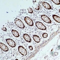 HSP90AA1 / Hsp90 Alpha A1 Antibody - Immunohistochemical analysis of HSP90 alpha staining in human colon cancer formalin fixed paraffin embedded tissue section. The section was pre-treated using heat mediated antigen retrieval with sodium citrate buffer (pH 6.0). The section was then incubated with the antibody at room temperature and detected using an HRP conjugated compact polymer system. DAB was used as the chromogen. The section was then counterstained with hematoxylin and mounted with DPX.