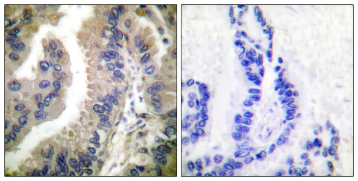 HSP90AA1 / Hsp90 Alpha A1 Antibody - Peptide - + Immunohistochemical analysis of paraffin-embedded human lung carcinoma tissue using HSP90 cyto antibody.