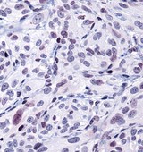hsp90aa1.1 Antibody - Immunohistochemistry: Hsp90A Antibody - Analysis of Hsp901a in human kidney carcinoma using DAB with hematoxylin counterstain.  This image was taken for the unconjugated form of this product. Other forms have not been tested.