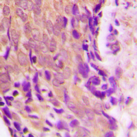 HSP90AB1 / HSP90 Alpha B1 Antibody - Immunohistochemical analysis of HSP90 beta staining in human prostate cancer formalin fixed paraffin embedded tissue section. The section was pre-treated using heat mediated antigen retrieval with sodium citrate buffer (pH 6.0). The section was then incubated with the antibody at room temperature and detected using an HRP conjugated compact polymer system. DAB was used as the chromogen. The section was then counterstained with hematoxylin and mounted with DPX.