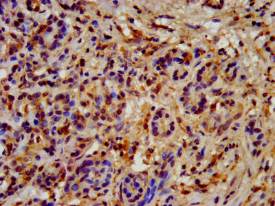 HSP90AB1 / HSP90 Alpha B1 Antibody - IHC image of HSP90AB1 Antibody diluted at 1:200 and staining in paraffin-embedded human pancreatic cancer performed on a Leica BondTM system. After dewaxing and hydration, antigen retrieval was mediated by high pressure in a citrate buffer (pH 6.0). Section was blocked with 10% normal goat serum 30min at RT. Then primary antibody (1% BSA) was incubated at 4°C overnight. The primary is detected by a biotinylated secondary antibody and visualized using an HRP conjugated SP system.