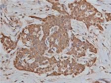 HSP90AB1 / HSP90 Alpha B1 Antibody - 1:50 staining human liver carcinoma tissues by IHC-P. The tissue was formaldehyde fixed and a heat mediated antigen retrieval step in citrate buffer was performed. The tissue was then blocked and incubated with the antibody for 1.5 hours at 22°C. An HRP conjugated goat anti-rabbit antibody was used as the secondary.