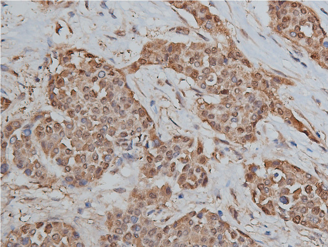HSP90AB1 / HSP90 Alpha B1 Antibody - 1:200 staining human liver carcinoma tissues by IHC-P. The tissue was formaldehyde fixed and a heat mediated antigen retrieval step in citrate buffer was performed. The tissue was then blocked and incubated with the antibody for 1.5 hours at 22°C. An HRP conjugated goat anti-rabbit antibody was used as the secondary.