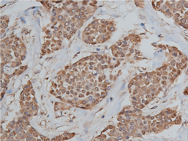 HSP90AB1 / HSP90 Alpha B1 Antibody - 1:200 staining human liver carcinoma tissues by IHC-P. The tissue was formaldehyde fixed and a heat mediated antigen retrieval step in citrate buffer was performed. The tissue was then blocked and incubated with the antibody for 1.5 hours at 22°C. An HRP conjugated goat anti-rabbit antibody was used as the secondary.