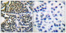 HSP90AB1 / HSP90 Alpha B1 Antibody - Peptide - + Immunohistochemical analysis of paraffin-embedded human breast carcinoma tissue using HSP90B (Ab-254) antibody.