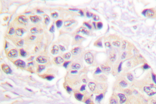 HSP90AB1 / HSP90 Alpha B1 Antibody - Immunohistochemistry (IHC) analysis of p-HSP90 beta (S254) pAb in paraffin-embedded human breast cancer tissue.
