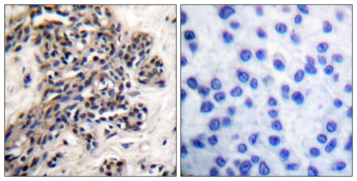 HSP90AB1 / HSP90 Alpha B1 Antibody - P-peptide - + Immunohistochemical analysis of paraffin-embedded human breast carcinoma tissue using HSP90B (phospho-Ser254) antibody.