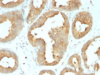 HSP90B1 / GP96 / GRP94 Antibody - Formalin-fixed, paraffin-embedded human breast carcinoma stained with GRP94 antibody (9G10.F8.2).  This image was taken for the unmodified form of this product. Other forms have not been tested.