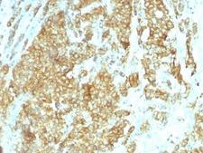 HSP90B1 / GP96 / GRP94 Antibody - Formalin-fixed, paraffin-embedded human breast carcinoma stained with GRP94 antibody (HSP90B1/1192).  This image was taken for the unmodified form of this product. Other forms have not been tested.