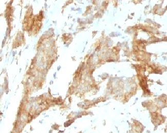 HSP90B1 / GP96 / GRP94 Antibody - Formalin-fixed, paraffin-embedded human breast carcinoma stained with gp96 antibody (SPM249).  This image was taken for the unmodified form of this product. Other forms have not been tested.