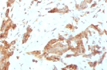 HSP90B1 / GP96 / GRP94 Antibody - IHC testing of FFPE human breast carcinoma with GRP94 antibody (clone SRPR90b).  This image was taken for the unmodified form of this product. Other forms have not been tested.