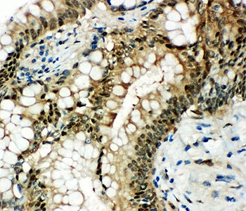 HSPA1A Antibody - IHC-P: HSP70 antibody testing of human intestinal cancer tissue