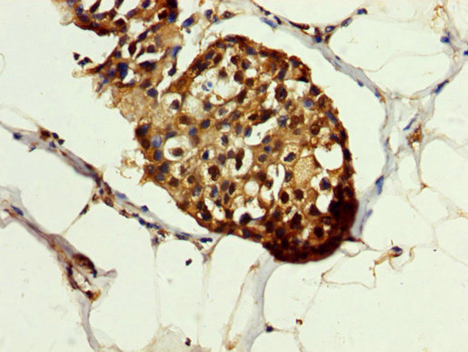 HSPA1A Antibody - Immunohistochemistry image at a dilution of 1:200 and staining in paraffin-embedded human breast cancer performed on a Leica BondTM system. After dewaxing and hydration, antigen retrieval was mediated by high pressure in a citrate buffer (pH 6.0) . Section was blocked with 10% normal goat serum 30min at RT. Then primary antibody (1% BSA) was incubated at 4 °C overnight. The primary is detected by a biotinylated secondary antibody and visualized using an HRP conjugated SP system.