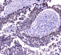 HSPA1A Antibody - IHC analysis of Hsp70 using anti-Hsp70 antibody. Hsp70 was detected in paraffin-embedded section of human lung cancer tissue. Heat mediated antigen retrieval was performed in citrate buffer (pH6, epitope retrieval solution) for 20 mins. The tissue section was blocked with 10% goat serum. The tissue section was then incubated with 2µg/ml mouse anti-Hsp70 antibody overnight at 4°C. Biotinylated goat anti-mouse IgG was used as secondary antibody and incubated for 30 minutes at 37°C. The tissue section was developed using Strepavidin-Biotin-Complex (SABC) with DAB as the chromogen.