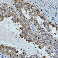 HSPA1L Antibody - Immunohistochemical analysis of HSP70 staining in human lung cancer formalin fixed paraffin embedded tissue section. The section was pre-treated using heat mediated antigen retrieval with sodium citrate buffer (pH 6.0). The section was then incubated with the antibody at room temperature and detected using an HRP conjugated compact polymer system. DAB was used as the chromogen. The section was then counterstained with hematoxylin and mounted with DPX.