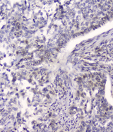 HSPA2 Antibody - IHC analysis of HSPA2 using anti-HSPA2 antibody. HSPA2 was detected in paraffin-embedded section of human lung cancer tissue. Heat mediated antigen retrieval was performed in citrate buffer (pH6, epitope retrieval solution) for 20 mins. The tissue section was blocked with 10% goat serum. The tissue section was then incubated with 2µg/ml mouse anti-HSPA2 antibody overnight at 4°C. Biotinylated goat anti-mouse IgG was used as secondary antibody and incubated for 30 minutes at 37°C. The tissue section was developed using Strepavidin-Biotin-Complex (SABC) with DAB as the chromogen.