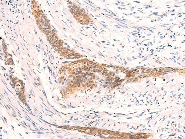 HSPA4L / APG-1 Antibody - Immunohistochemistry of paraffin-embedded Human esophagus cancer tissue  using HSPA4L Polyclonal Antibody at dilution of 1:30(×200)