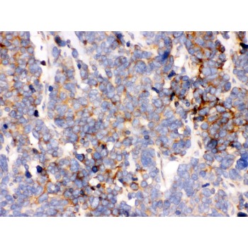 HSPA5 / GRP78 / BiP Antibody - GRP78 BiP antibody IHC-paraffin. IHC(P): Human Lung Cancer Tissue.